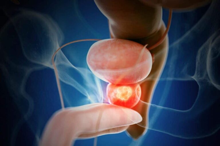 diagnostico-temprano-y-terapias-innovadoras:-asi-avanza-la-lucha-contra-el-cancer-de-prostata