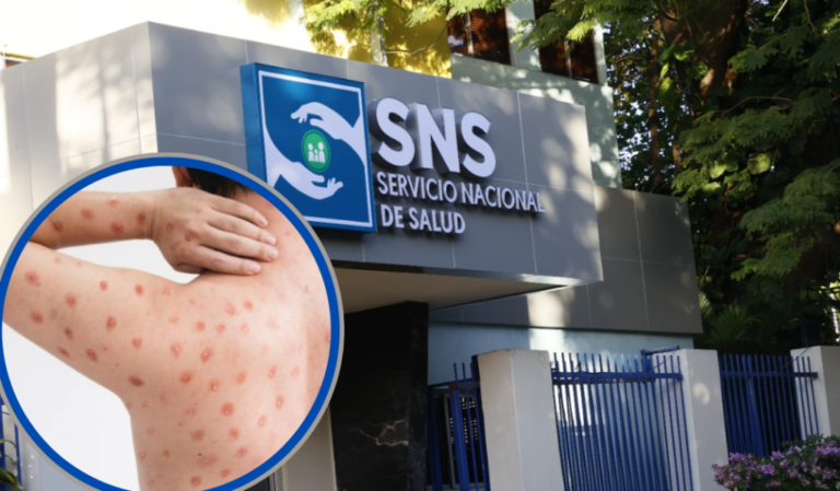 SNS asegura que hospitales activaron protocolos ante detección del virus de la viruela